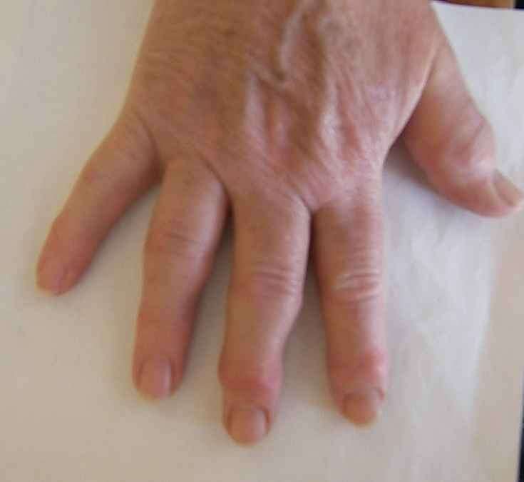 Artrite, sintomo della porpora