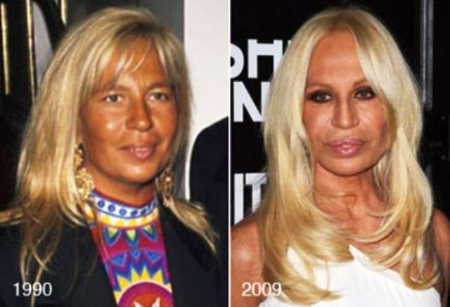 Donatella Versace prima e dopo