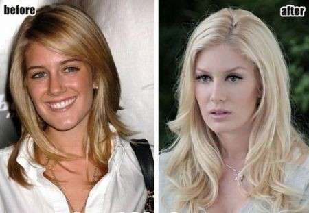 Heidi Montag prima e dopo