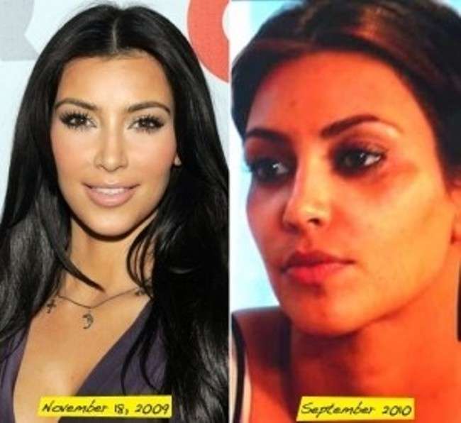 Kim Kardashian prima e dopo