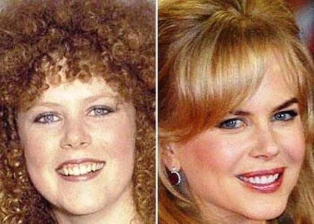 Nicole Kidman prima e dopo