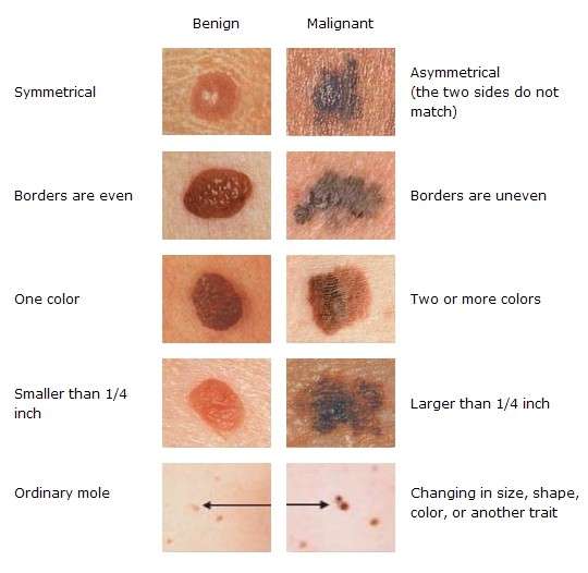 Distinguere il melanoma