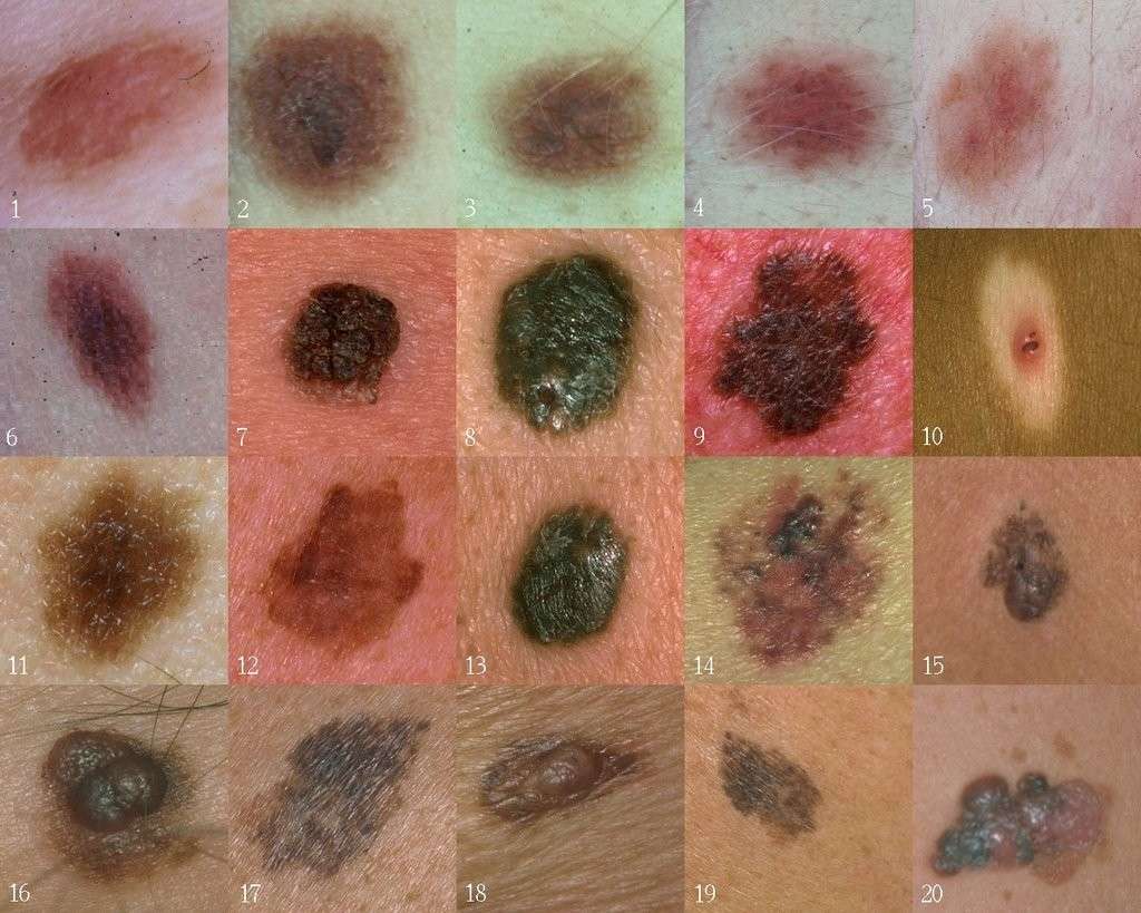 Diversi tipi di melanoma