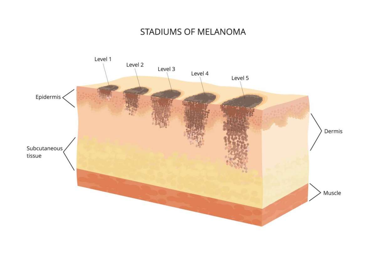 Gli stadi del melanoma