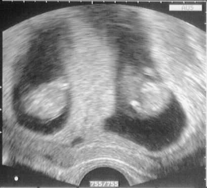 Gravidanza gemellare: immagini dell'ecografia