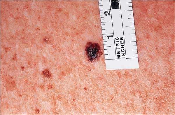 Il tumore della pelle