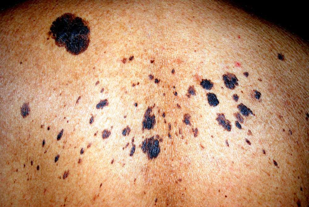 Melanoma a diffusione superficiale