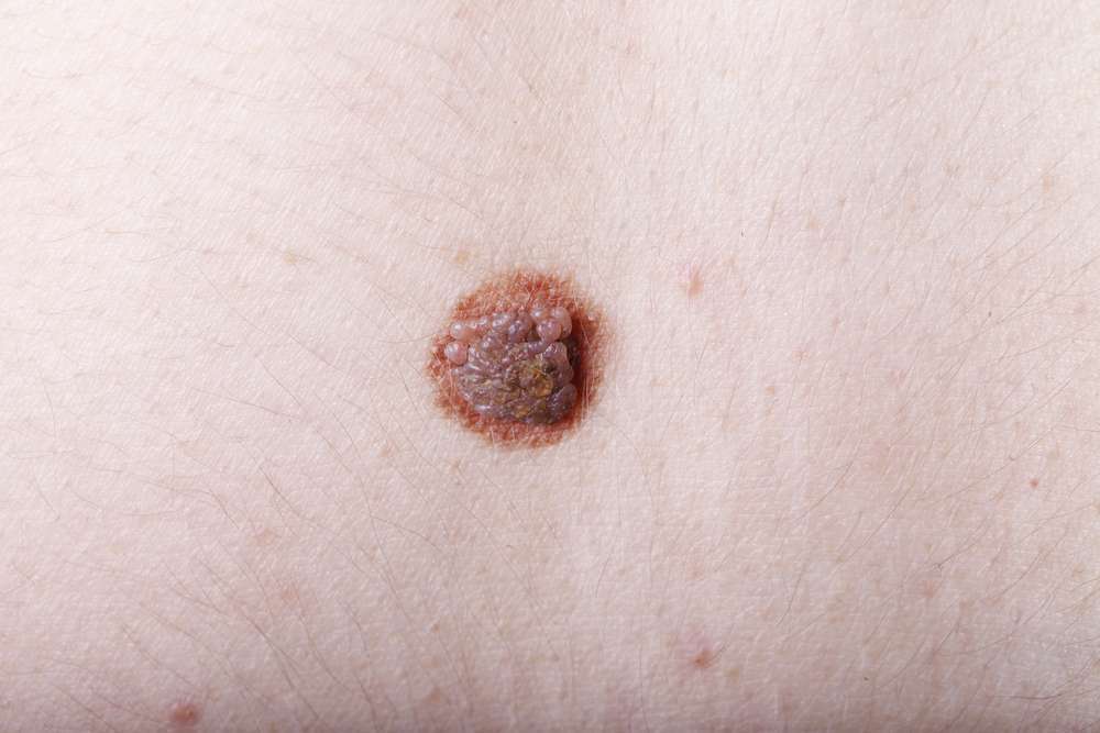 Melanoma della pelle