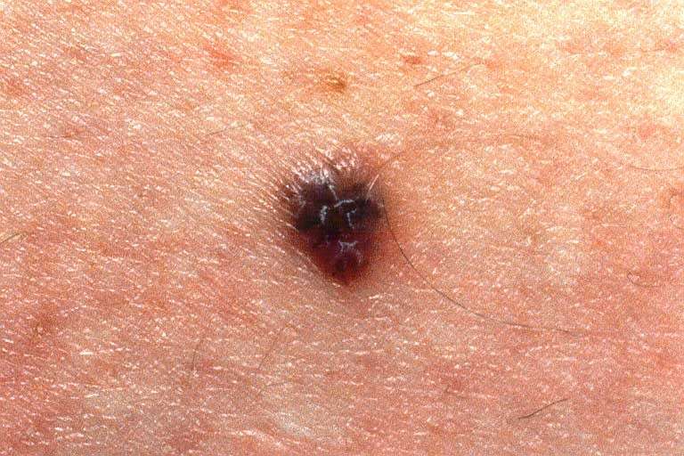 Melanoma maligno