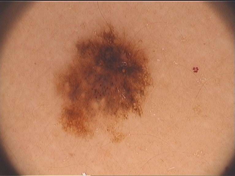 Melanoma sulla pelle