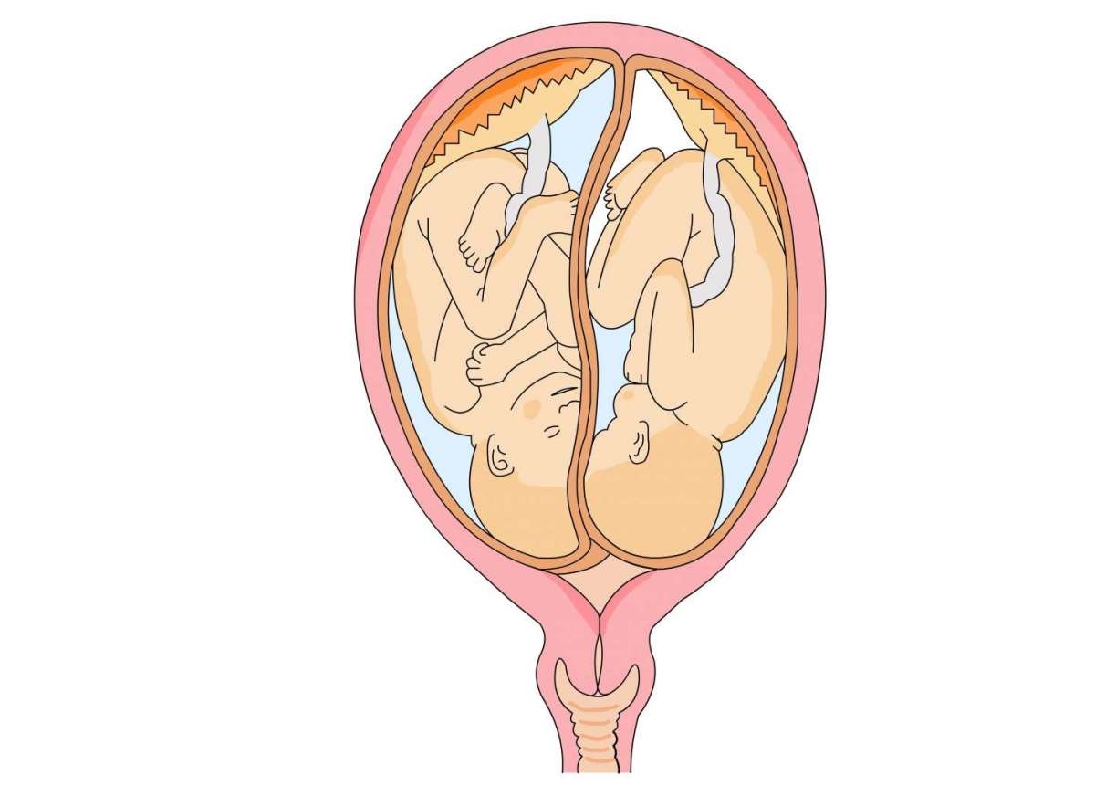 Posizione dei gemelli alla nascita