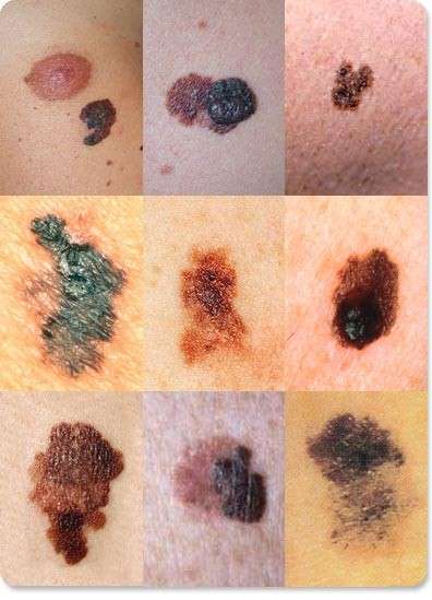 Riconoscere il melanoma