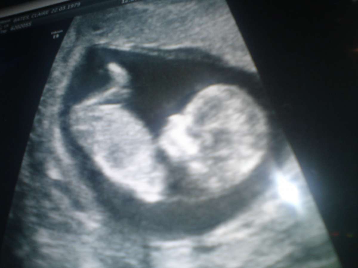 Gravidanza feto 12ma settimana