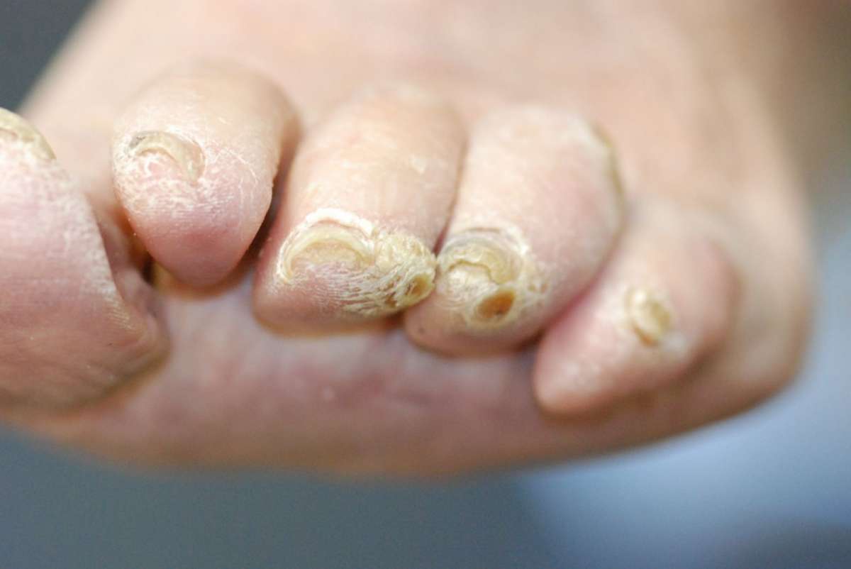 Dita dei piedi affette da micosi