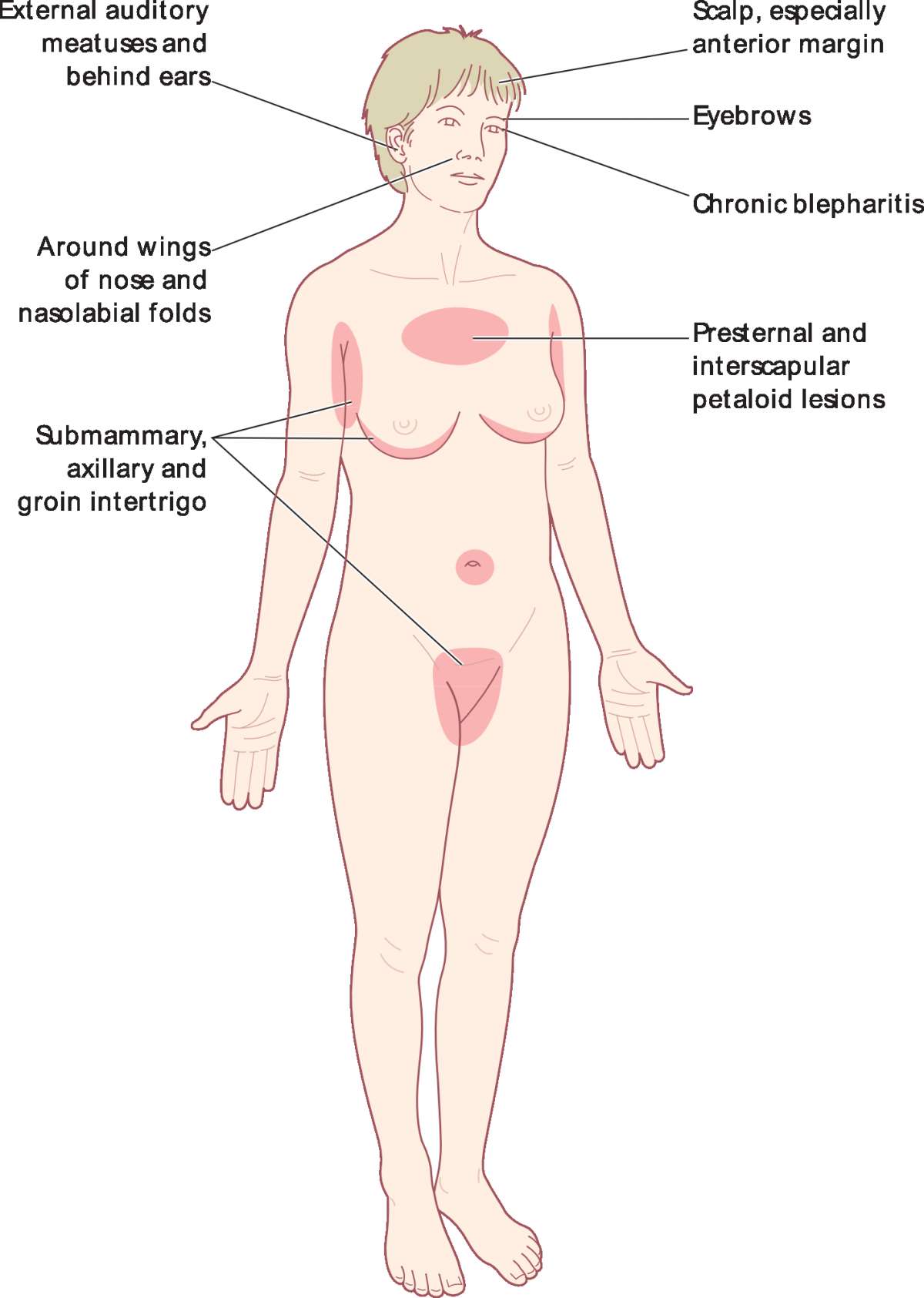 Eczema aree di diffusione