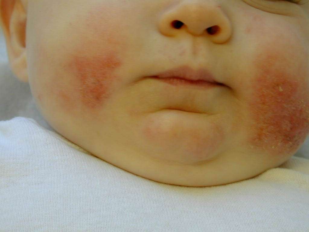 Eczema atopico del neonato