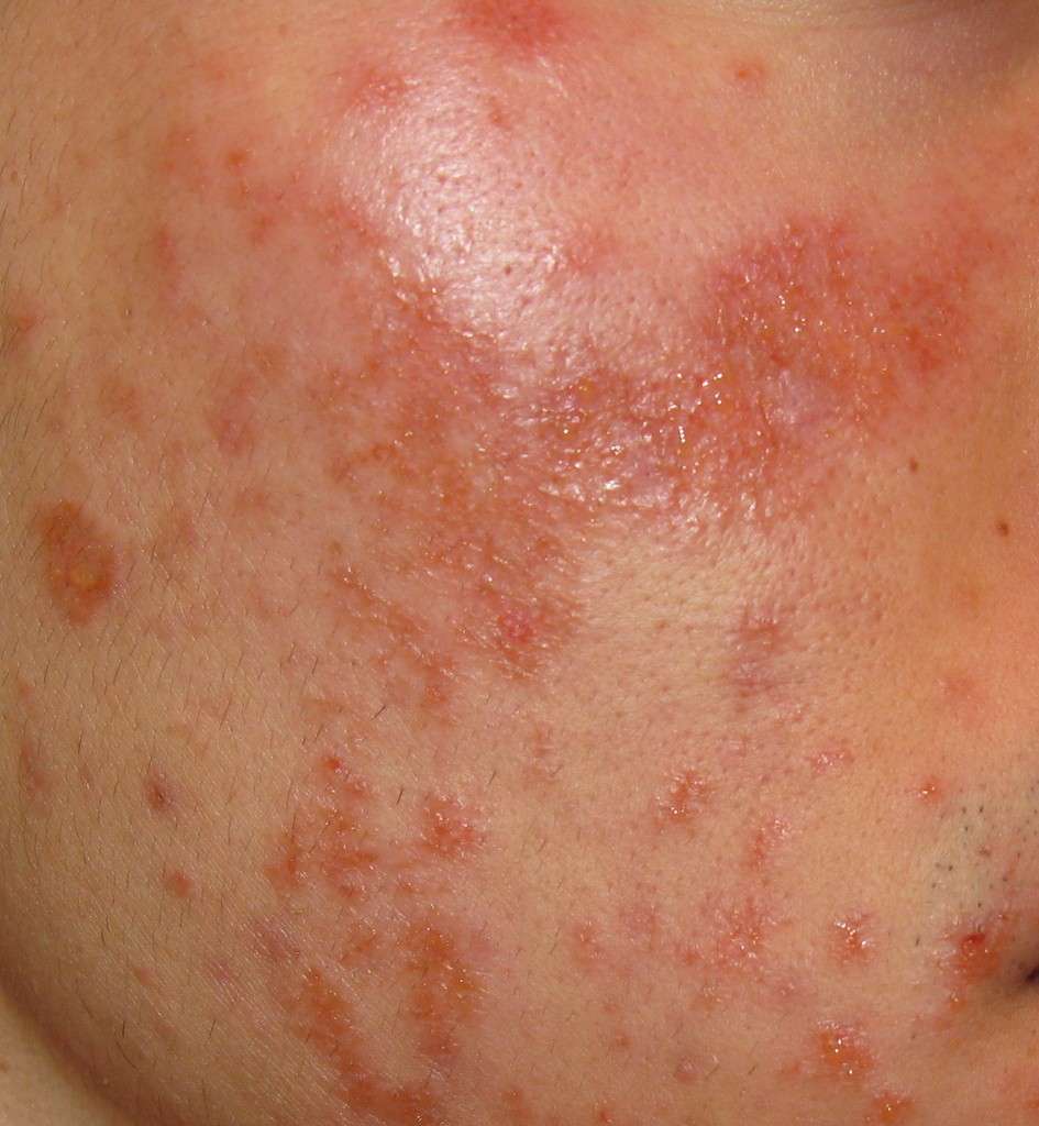 Eczema caratteristiche