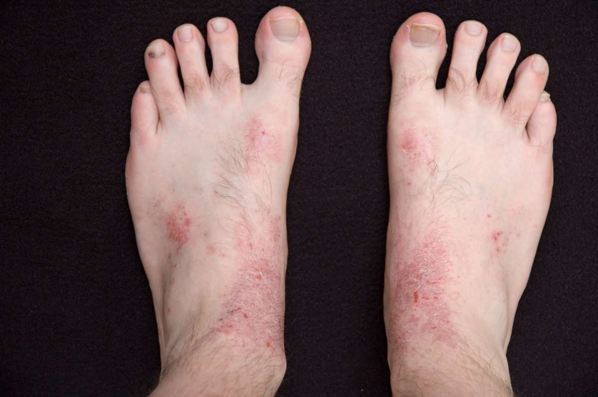 Eczema dei piedi