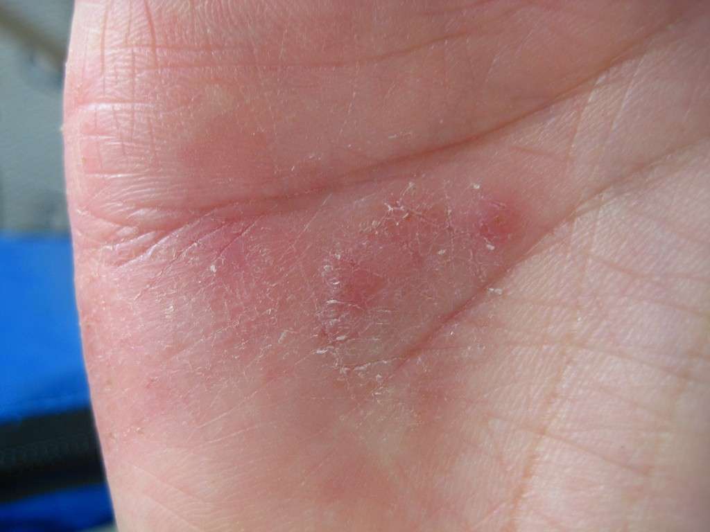 Eczema del palmo della mano