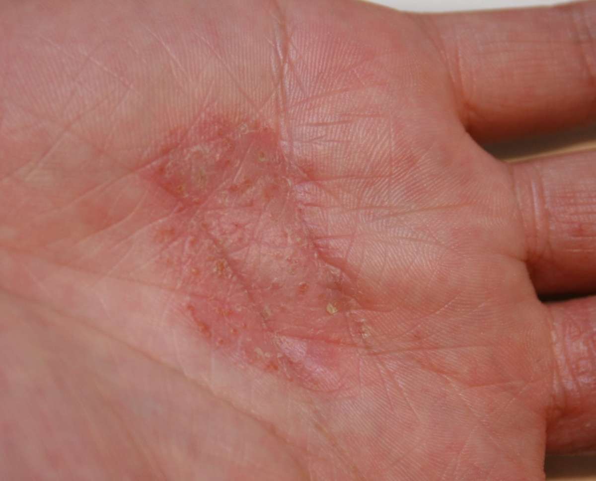 Eczema del palmo
