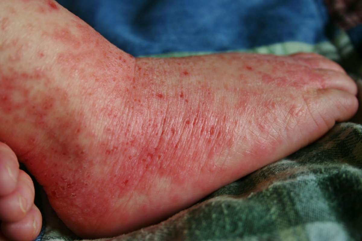 Eczema del piede