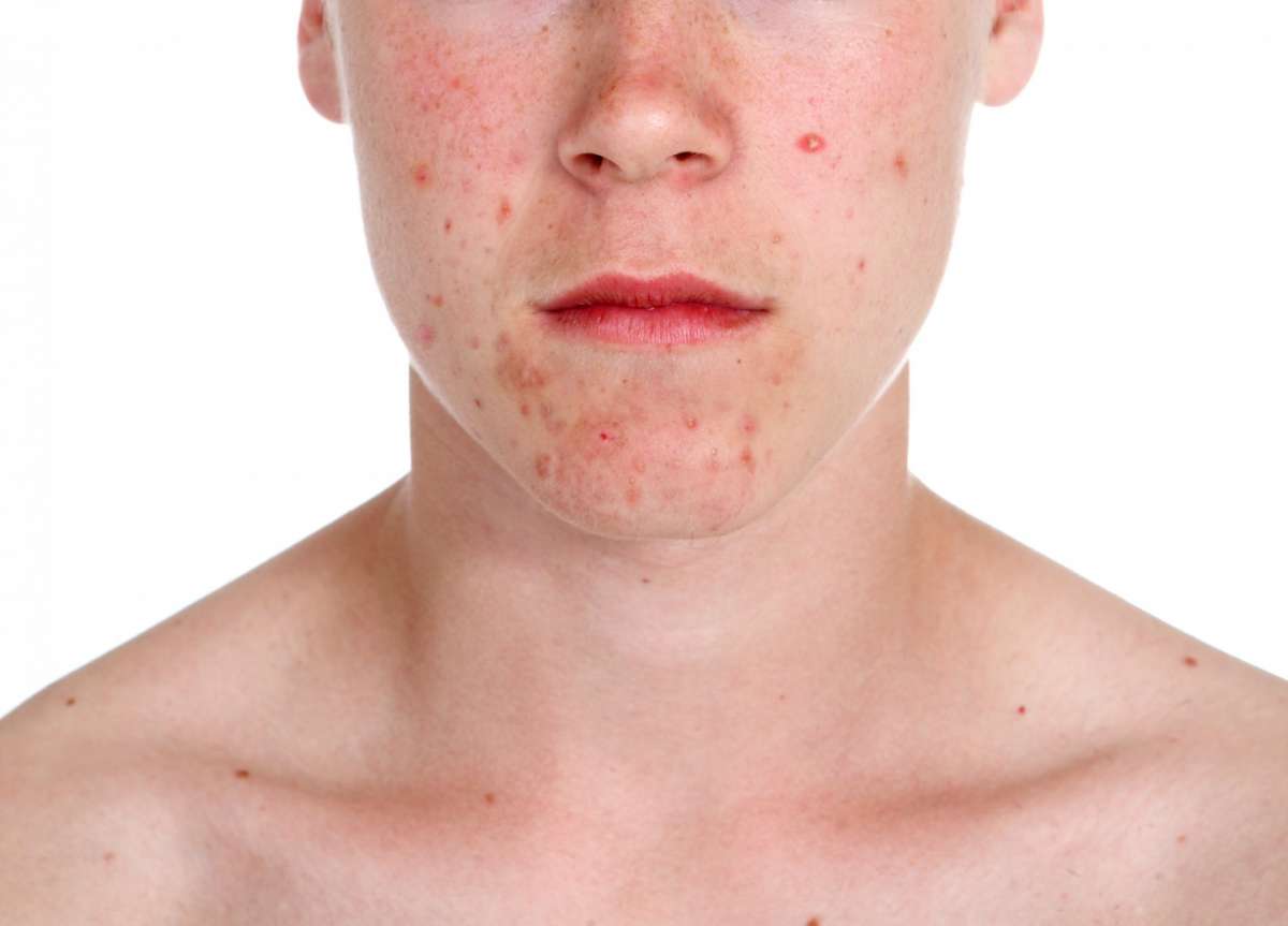 Eczema del viso