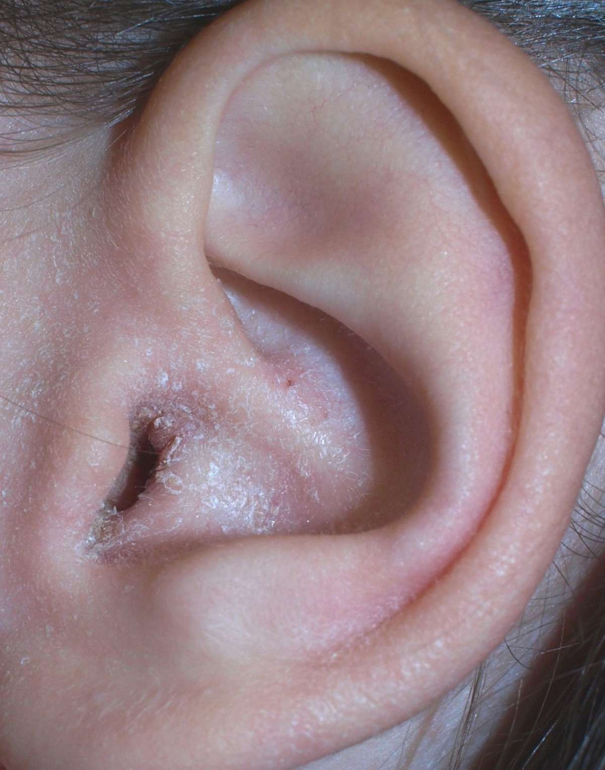 Eczema dell'orecchio