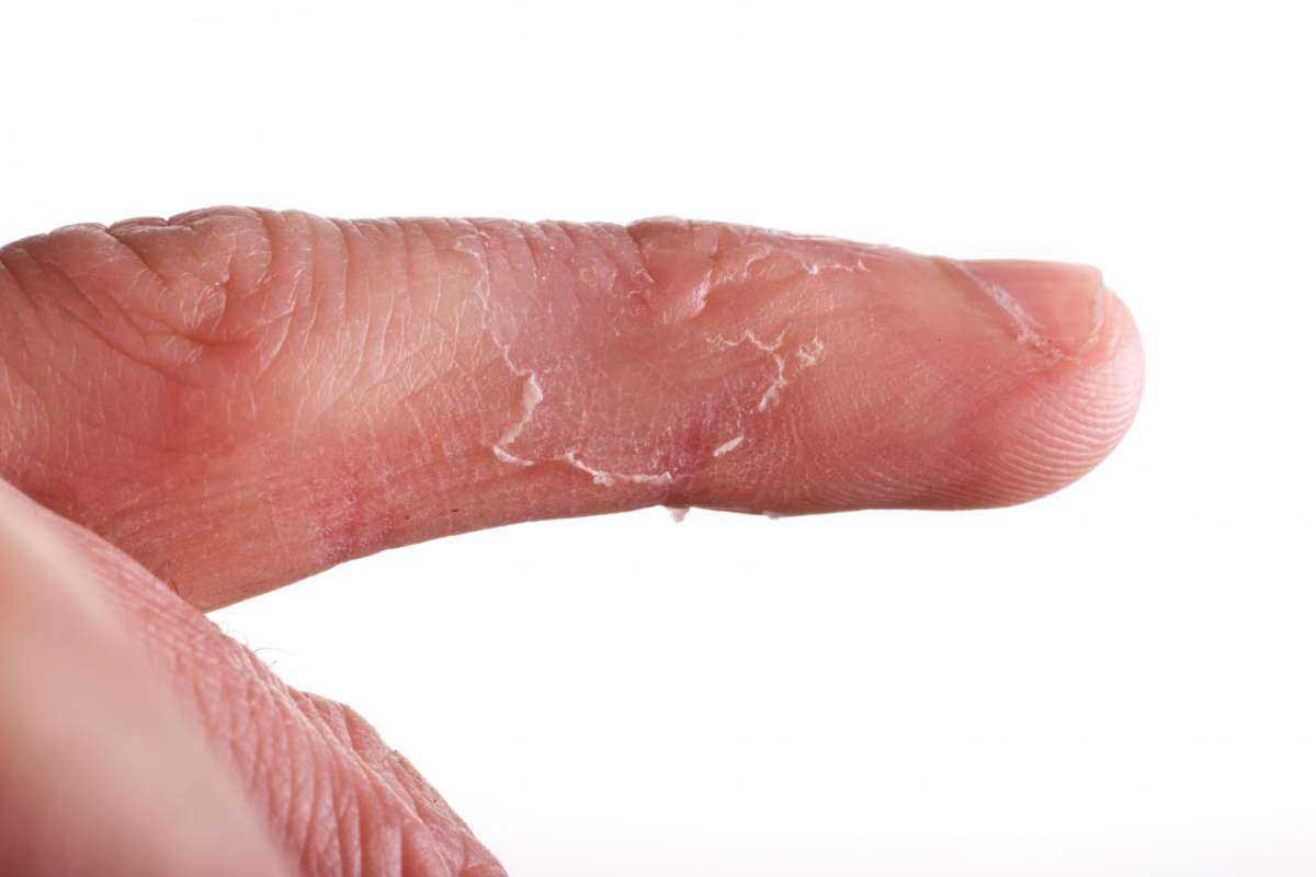 Eczema della dita
