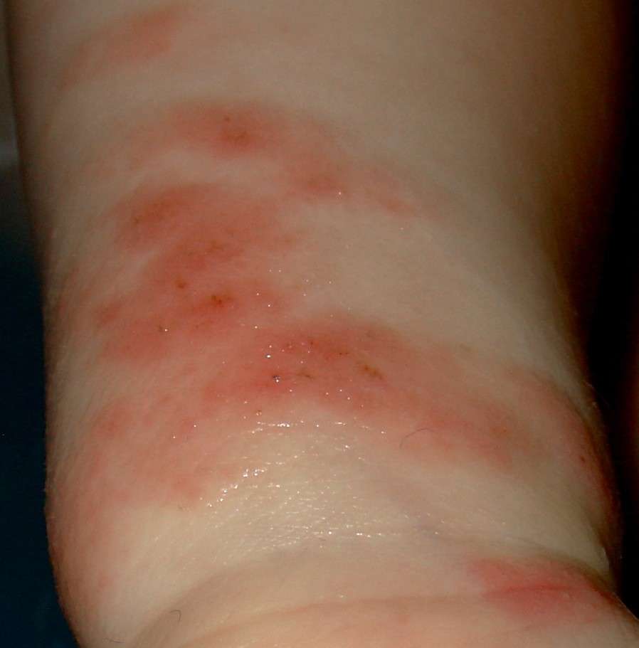 Eczema della gamba