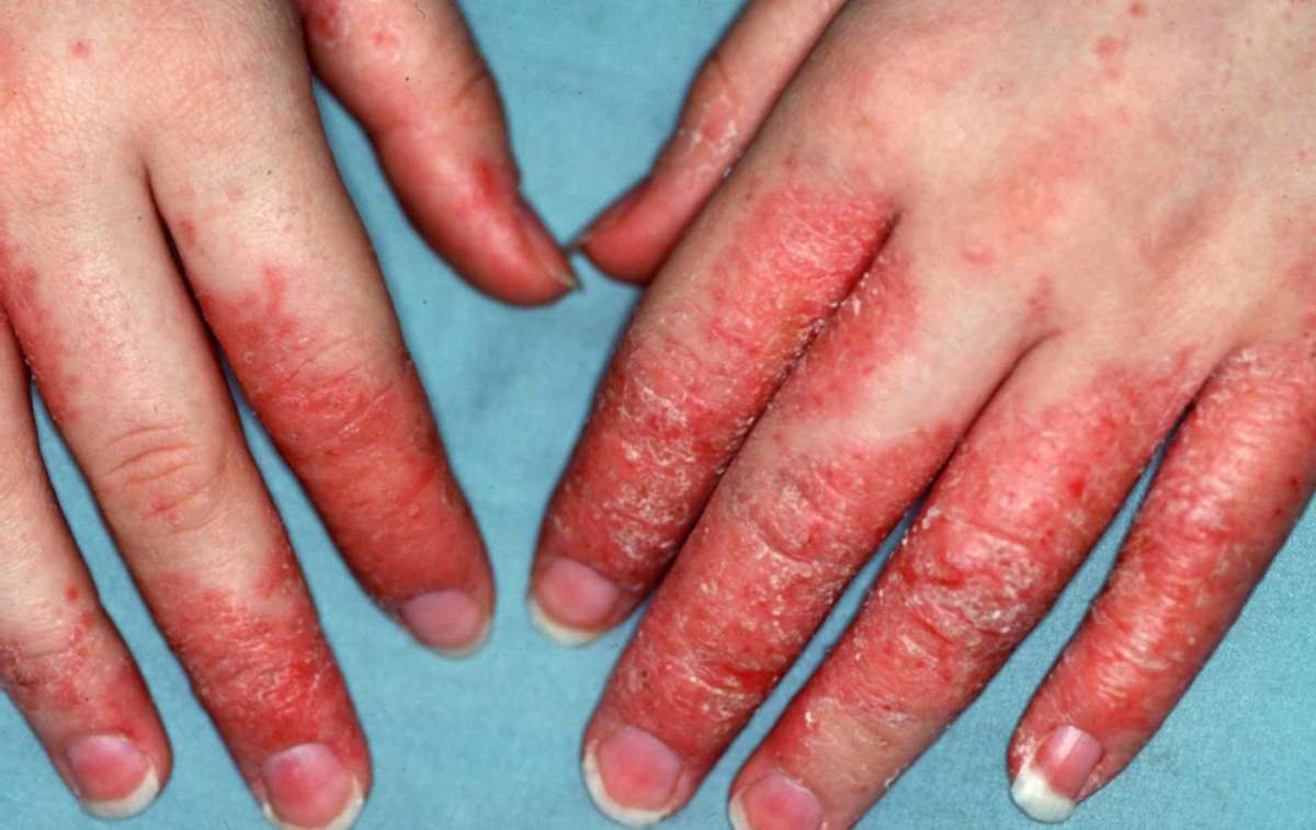 Eczema delle mani