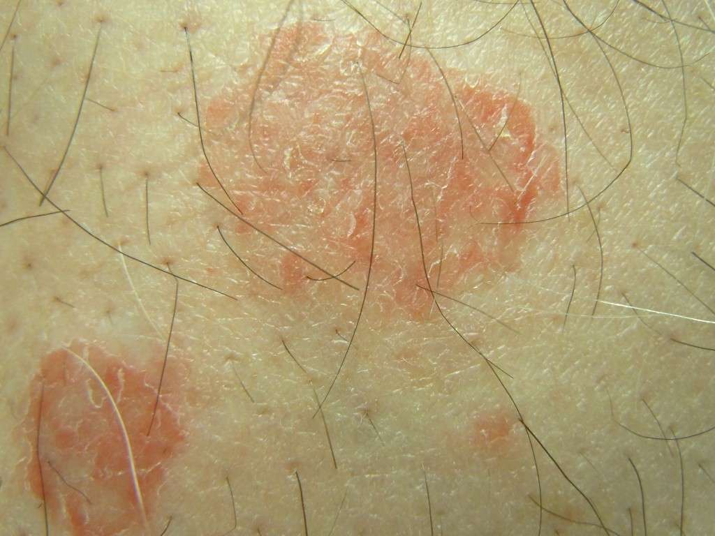 Eczema nummullare