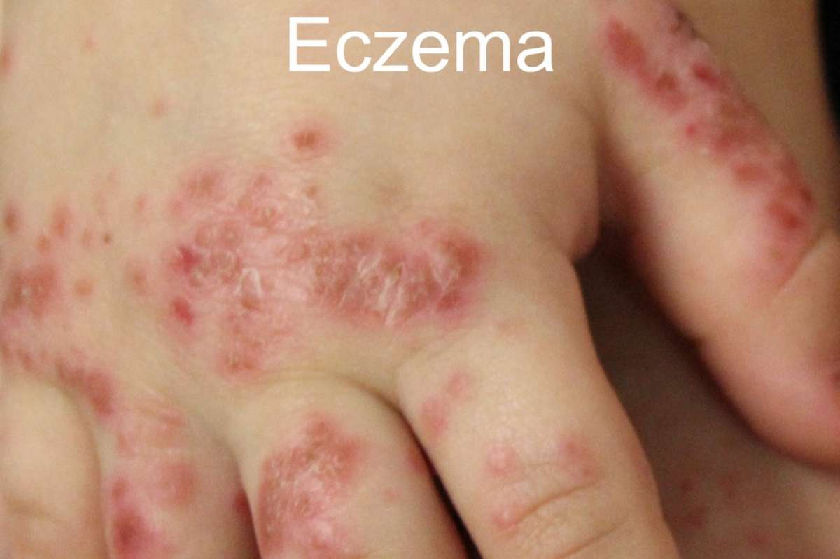 Eczema