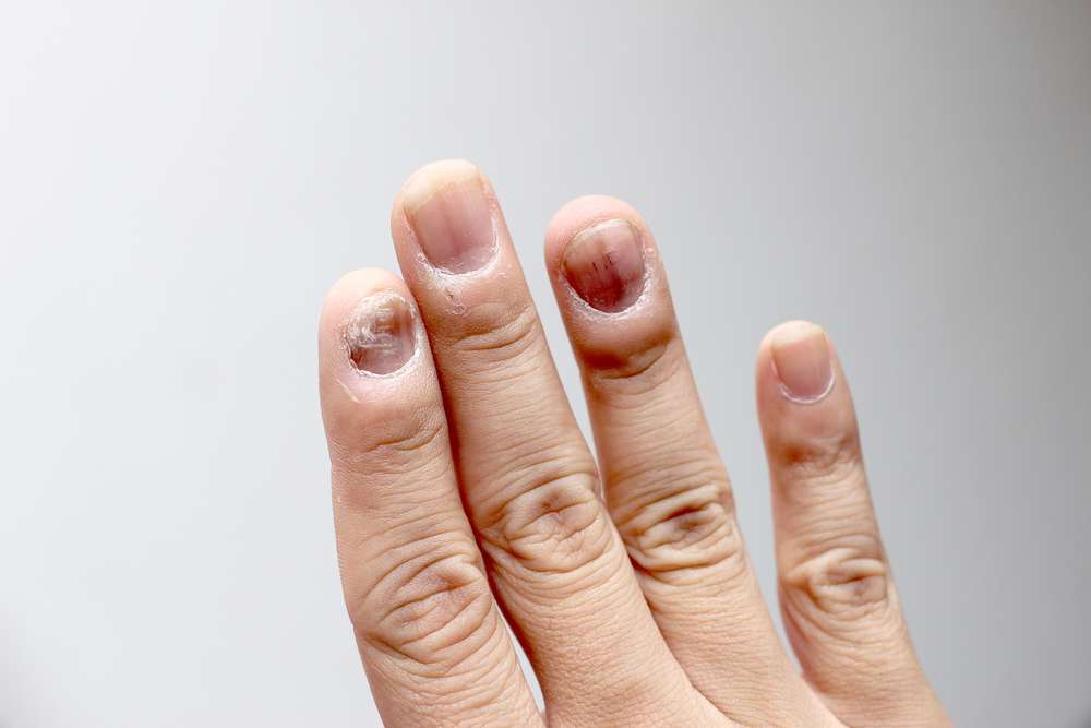 Infezione alle unghie della mano
