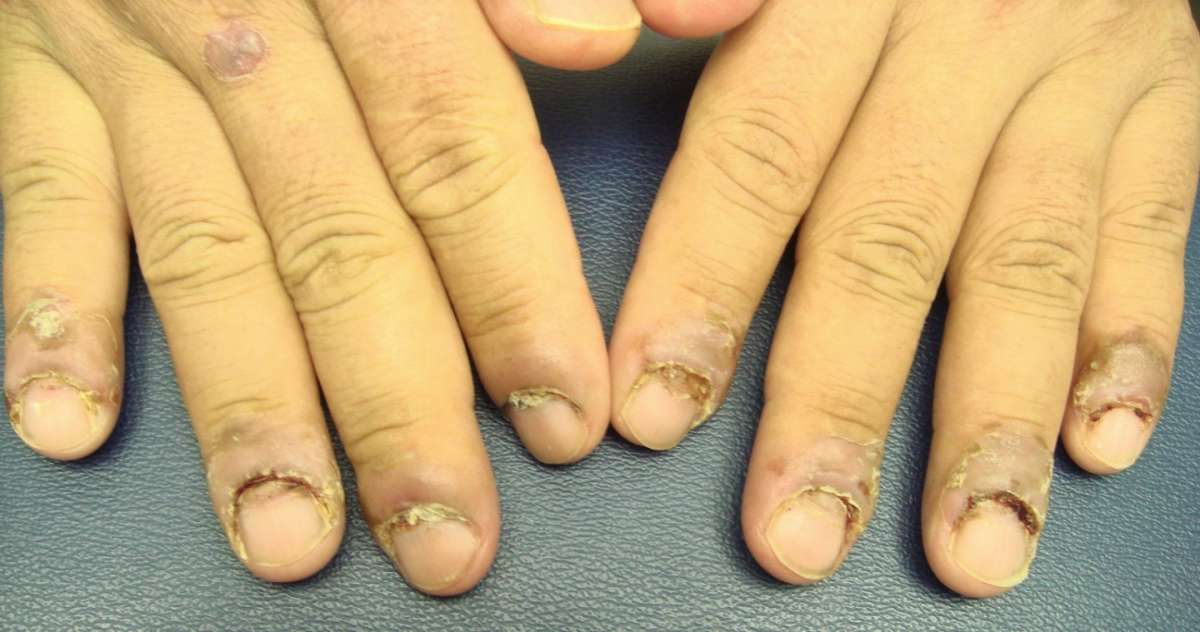 Mani con micosi delle unghie