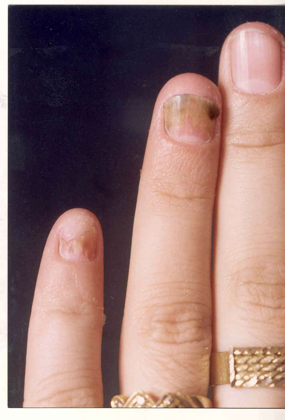 Mano di donna colpita da onicomicosi