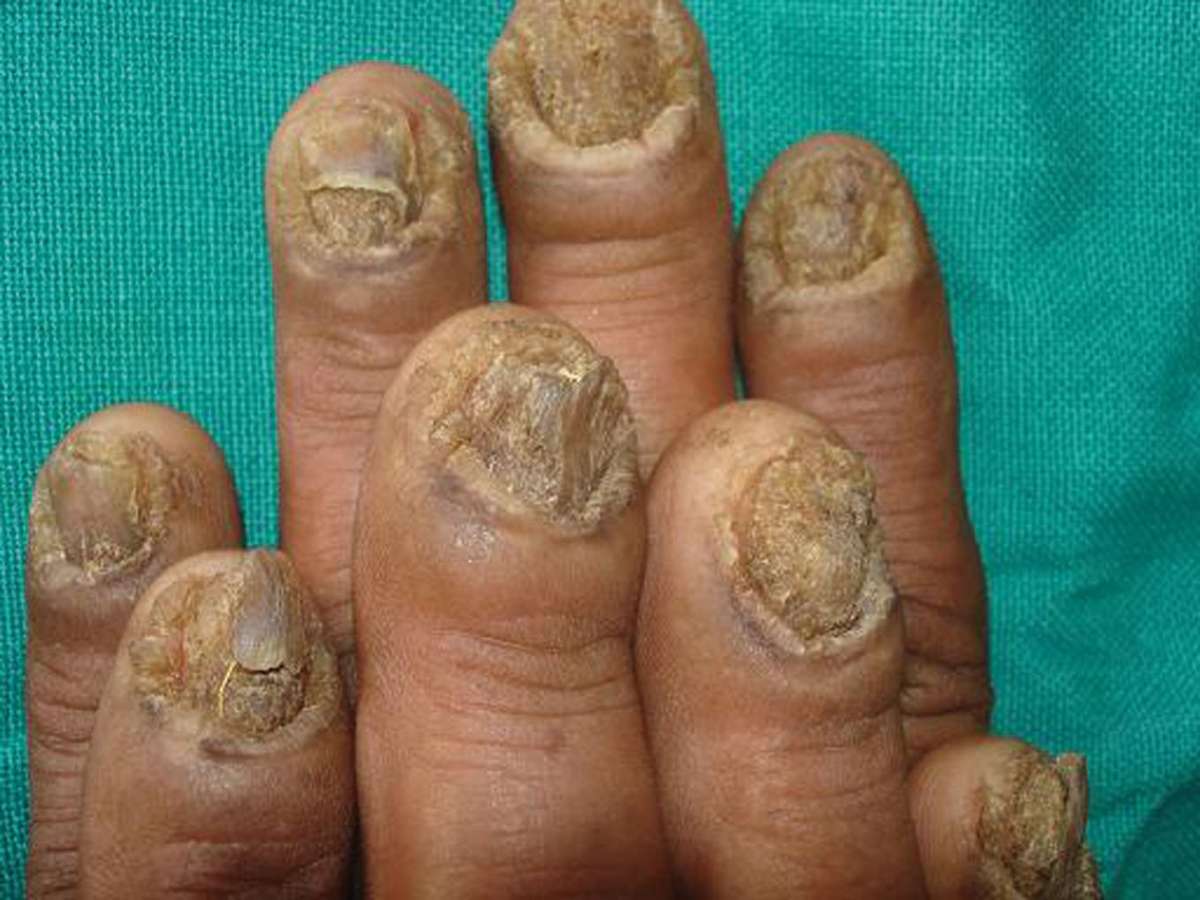 Onicomicosi alle unghie delle mani