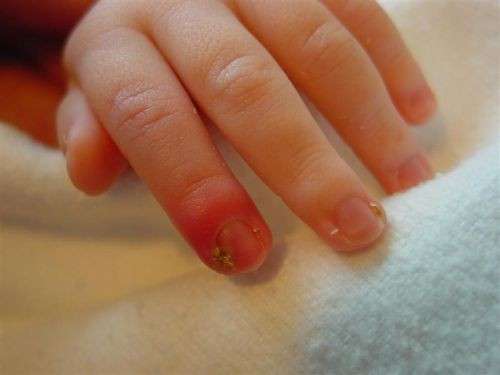 Onicomicosi del bambino