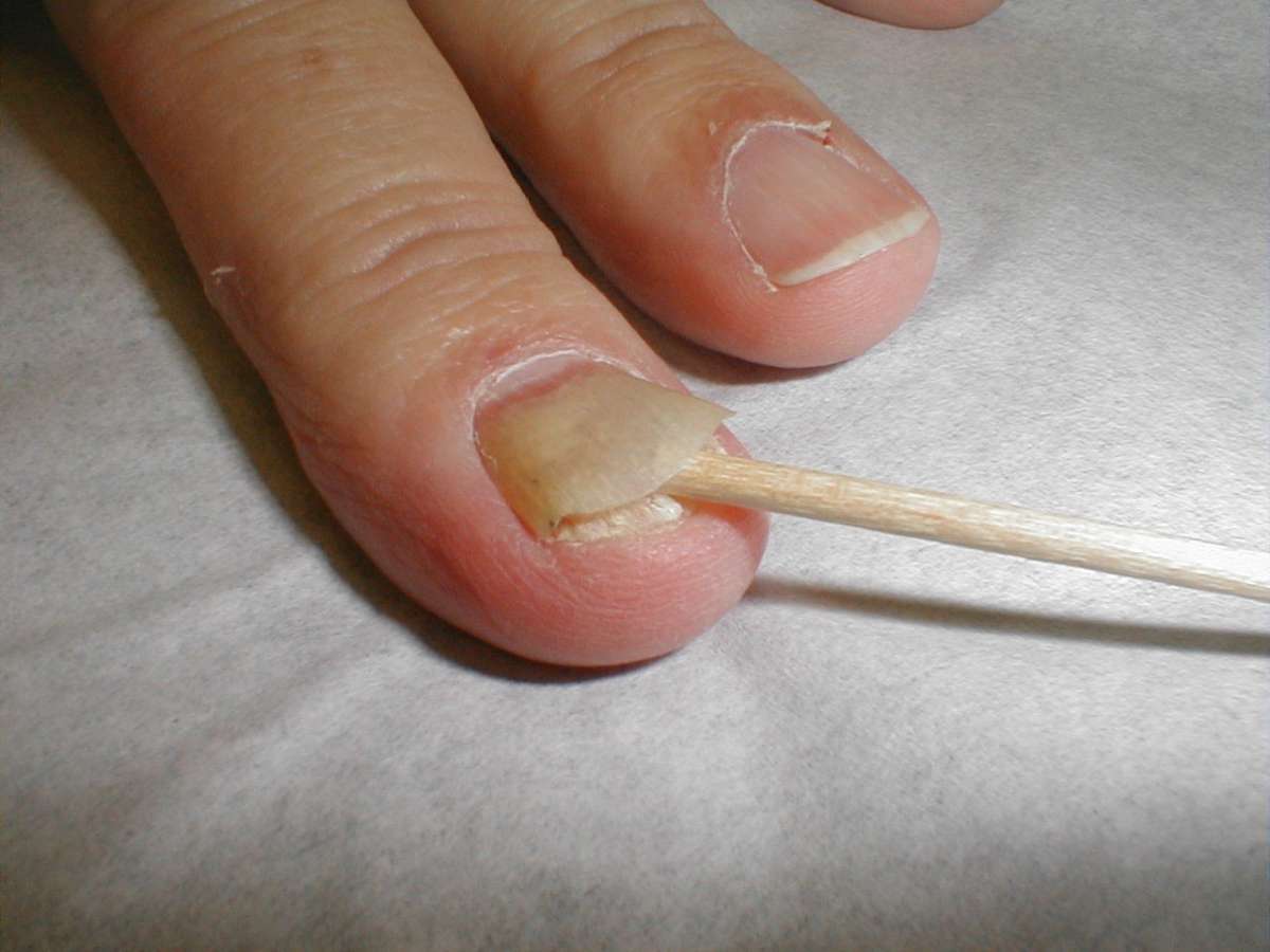 Onicomicosi diagnosi