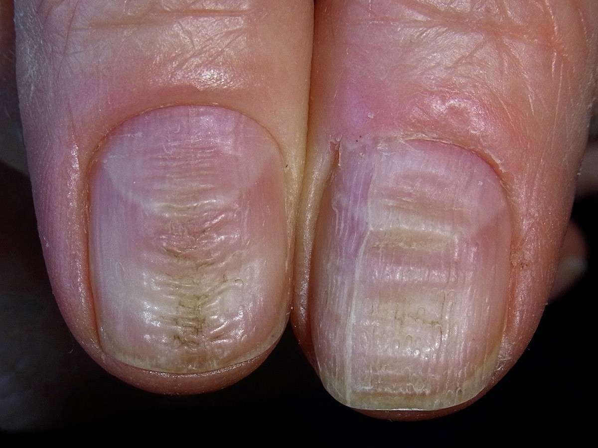 Onicomicosi unghie deformate