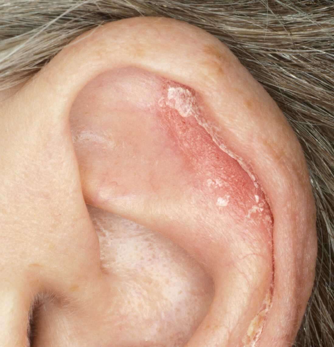 Piega dell'orecchio