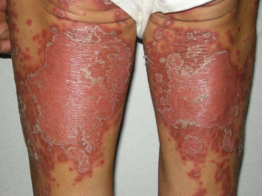 Psoriasi parte posteriore gambe