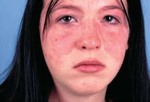 Eritema tipico del lupus