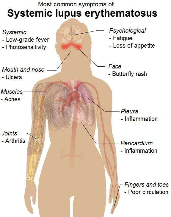 I sintomi del lupus