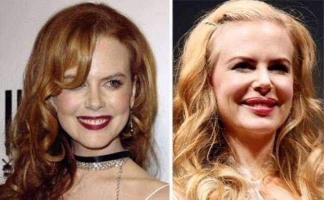 L'attrice prima e dopo il botox