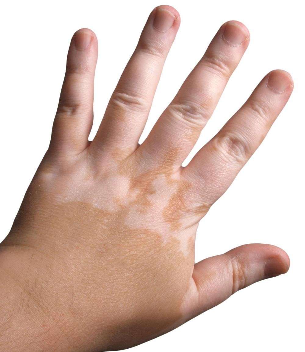 Macchie da Vitiligine nel bambino