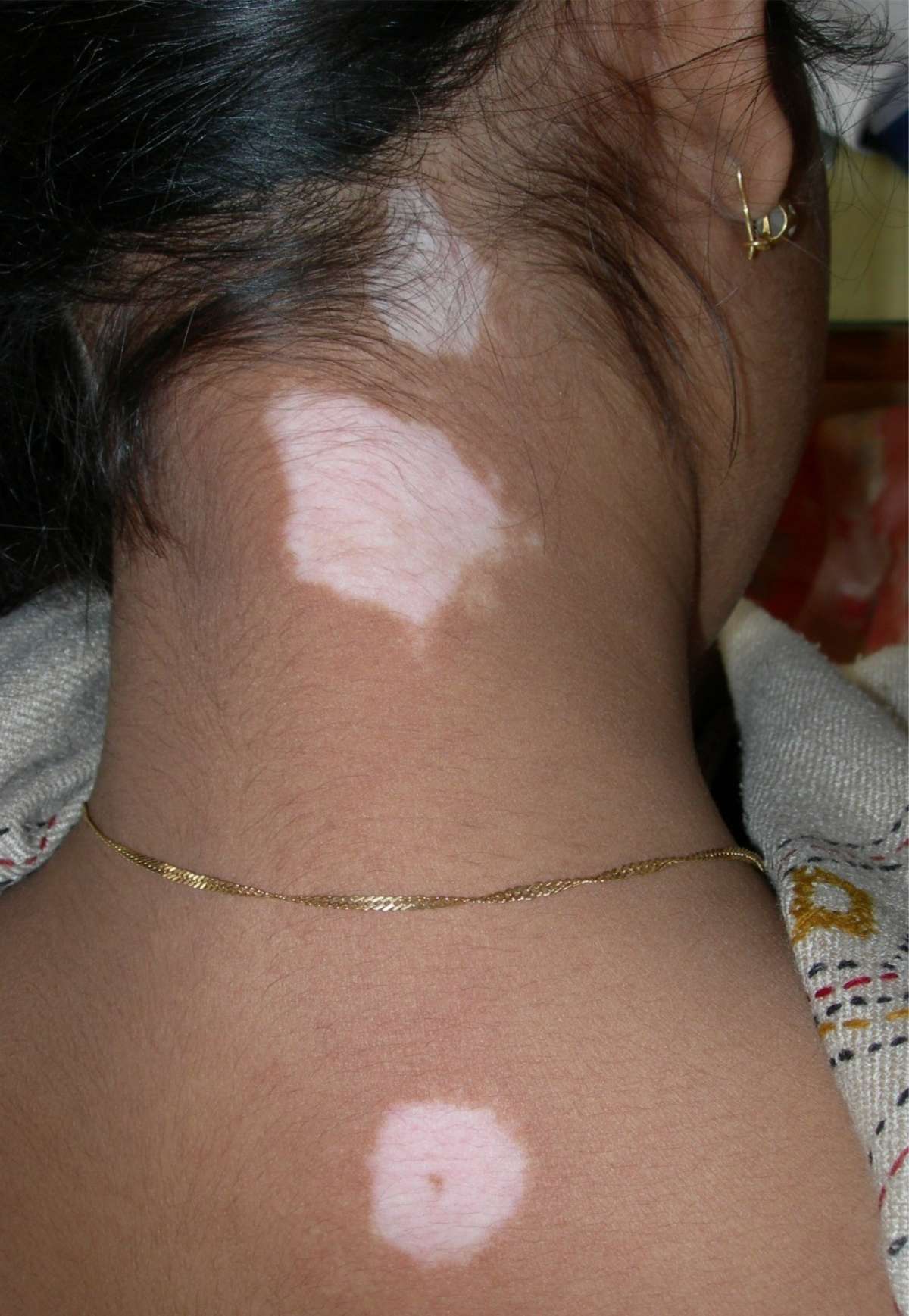Macchie da Vitiligine su nuca e collo