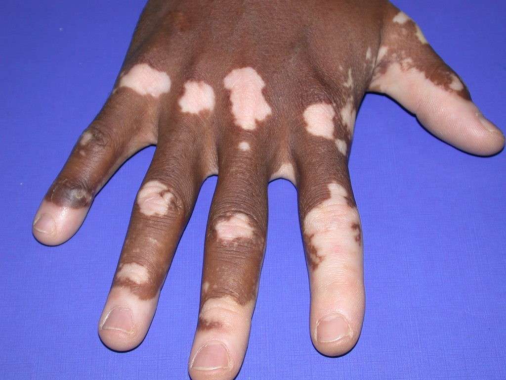 Macchie da Vitiligine su persona di colore
