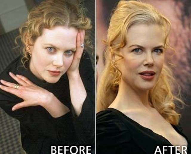 Nicole Kidman prima e dopo il ritocco