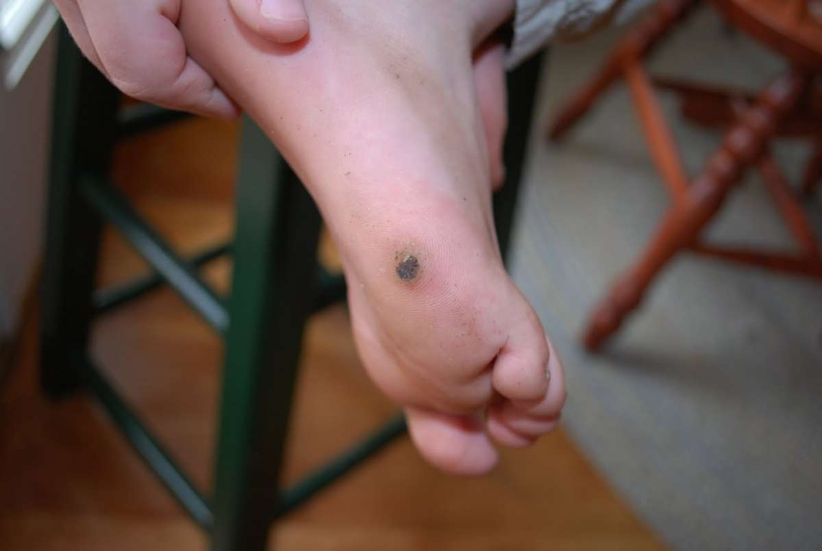 Porro annerito