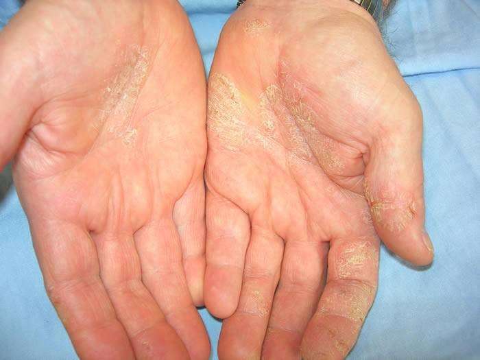 Dermatite sui palmi delle mani